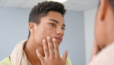 acné et bouton adolescent à la peau noire et metissée