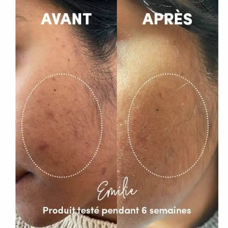 Atténuation des taches visage après utilisation du Nettoyant Exfoliant Visage en Poudre WAAM - Photo avant / après