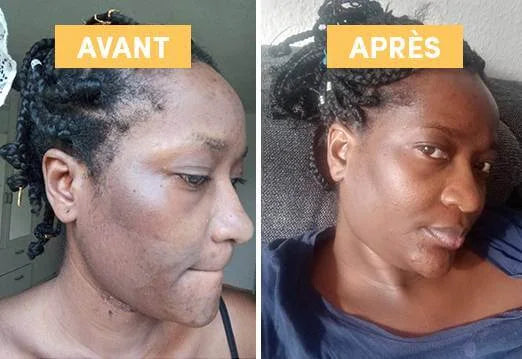Avant / AprÚs utilisation macérat huileux de busserole WAAM sur peau noire avec taches d'hyperpigmentation