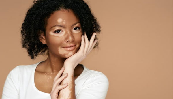 Le vitiligo sur peau noire | Diouda
