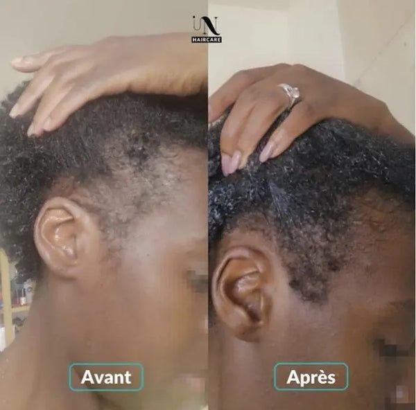 In Haircare avant/après cure d'1 mois complément alimentaire Cheveux Croissance capillaire In Haircare 
