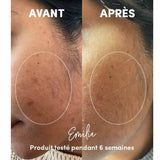 Atténuation des taches visage après utilisation du Nettoyant Exfoliant Visage en Poudre WAAM - Photo avant / après