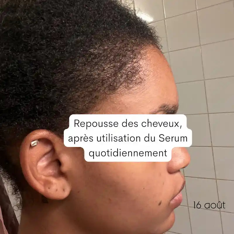 Résultat Après Repousse des cheveux sur les tempes dégarnies avec le Sérum anti-chute Chebhair