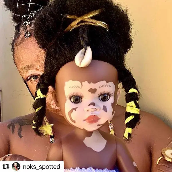 Poupée noire atteinte de vitiligo Ndanaka | Sibahle Collection 